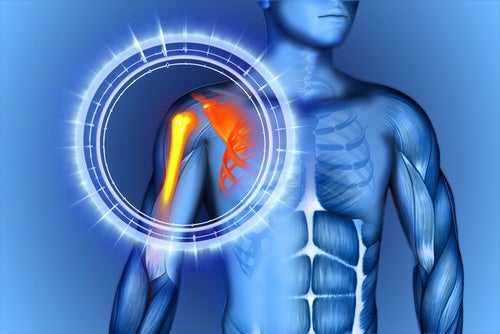 Osteonecrosis o necrosis avascular: causas, síntomas y tratamiento
