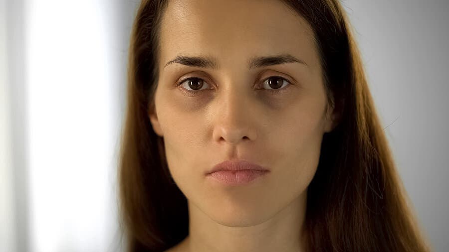 Mujer cansada con ojeras y párpados hinchados.