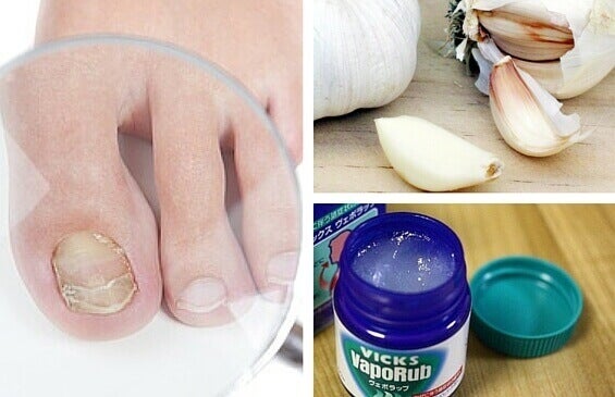 Cómo eliminar hongos en las uñas