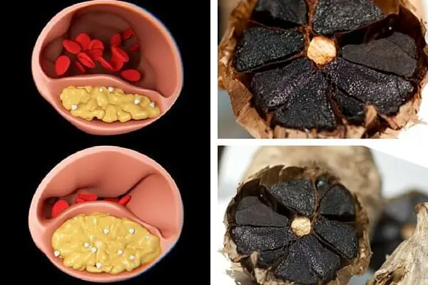 Ajo negro: un remedio eficaz para tratar el colesterol