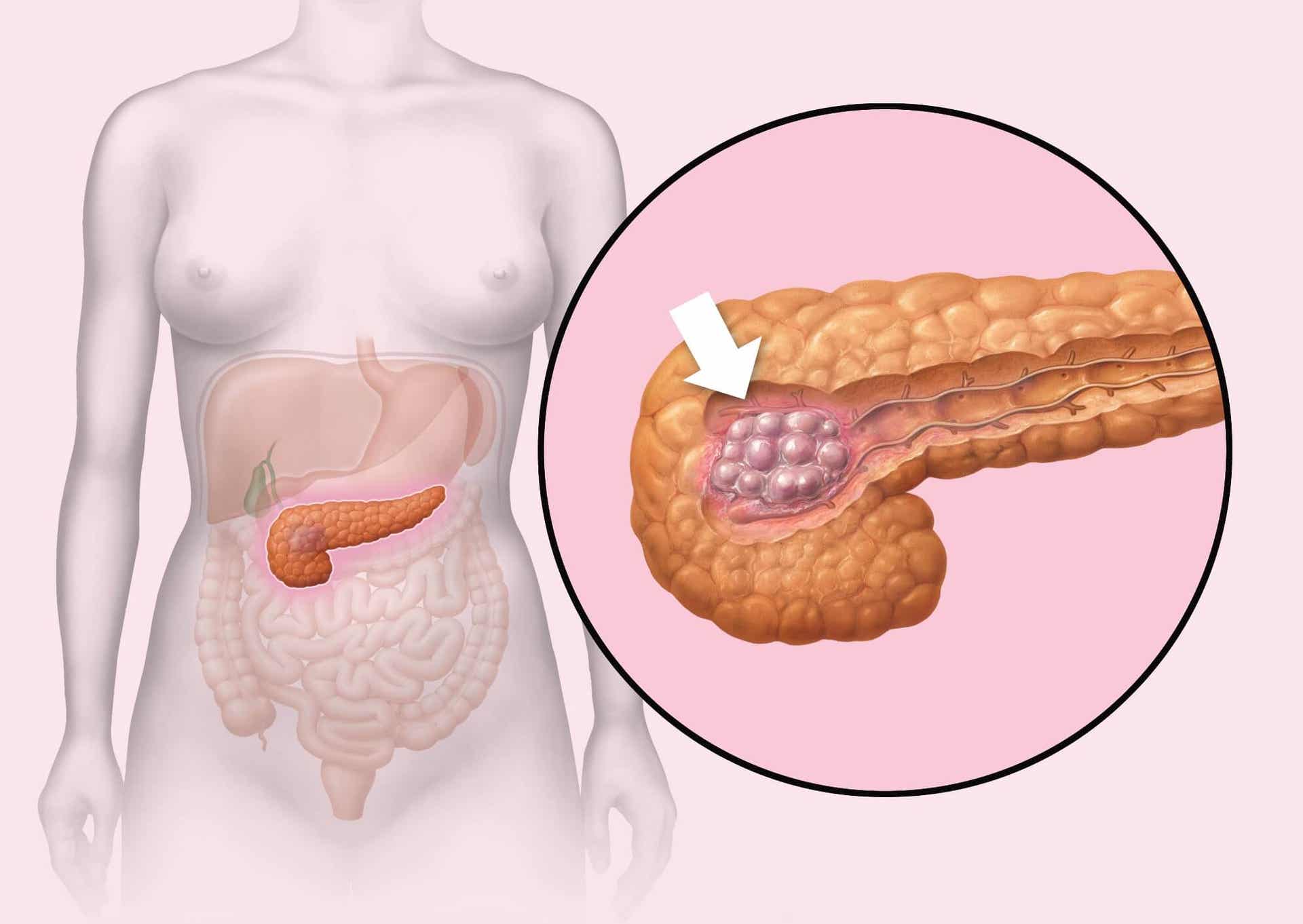 Enfermedades del páncreas: cáncer