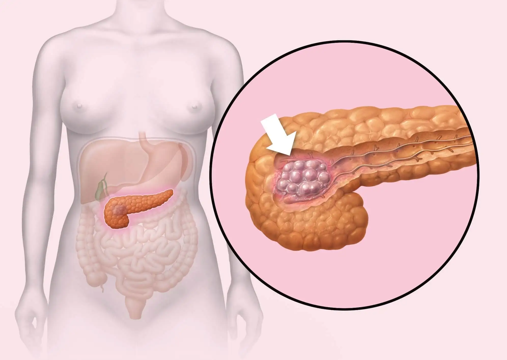 Enfermedades del páncreas: cáncer