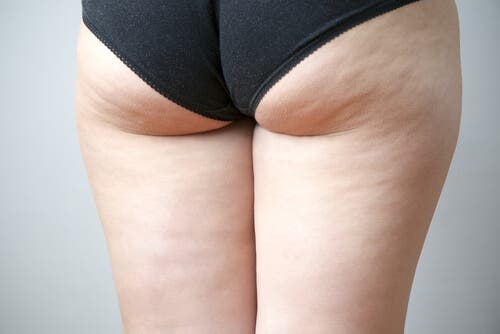 7 alimentos que pueden empeorar la celulitis