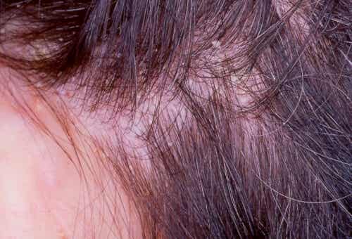 Tratamiento para los eccemas en el cuero cabelludo