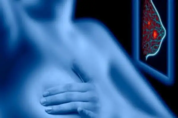 Mamografía, beneficios y riesgos