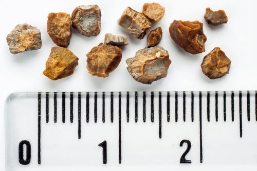 Cómo eliminar las piedras en el riñón