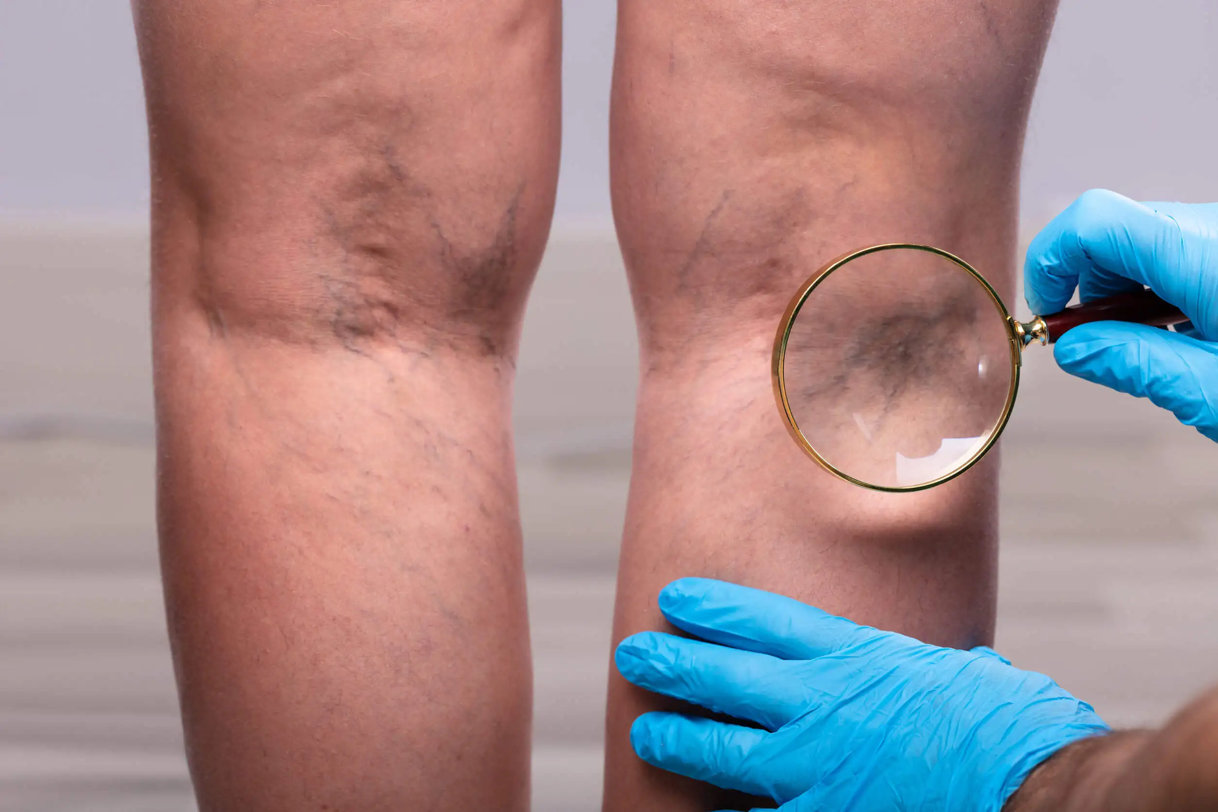 Piernas hinchadas por beriberi.