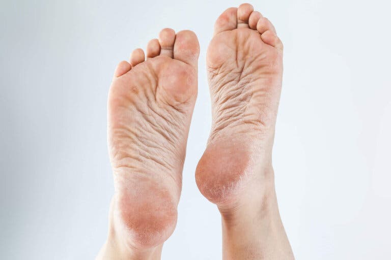 3 cremas naturales para eliminar los callos de los pies