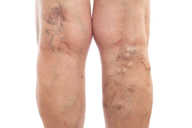 Las piernas hinchadas podrían ser el indicio de un problema de salud más grave