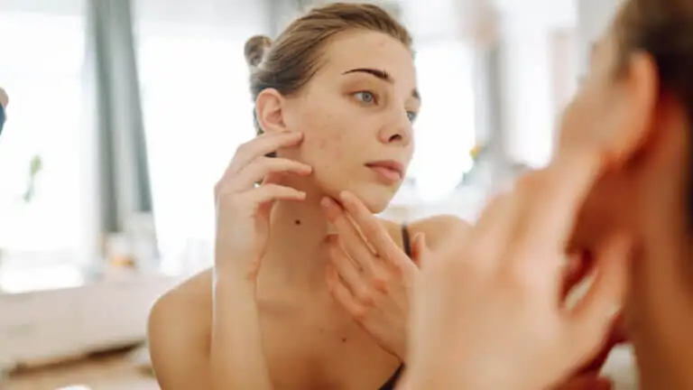 Levadura de cerveza para tratar el acné