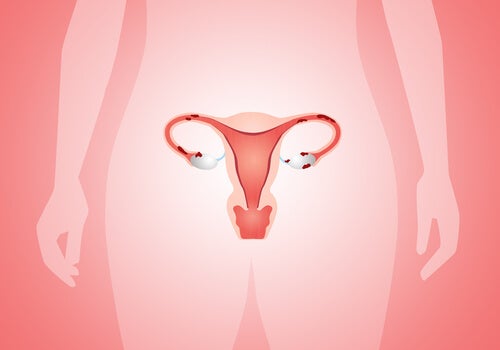 útero con endometriosis