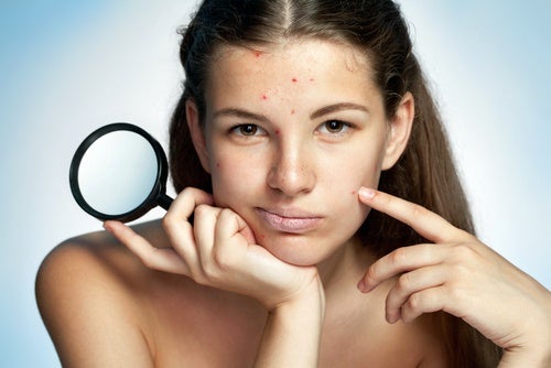 El-acne-tiene-una-estrecha-relacion-con-el-estres