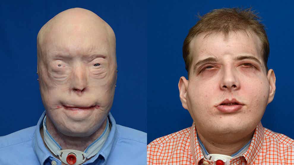 Un bombero de 41 años recibe el trasplante de cara más completo en la historia