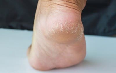 4 cremas caseras para tratar los talones secos y agrietados