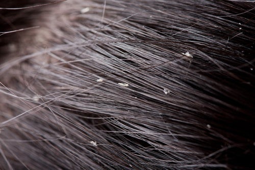 7 remedios naturales para combatir la caspa