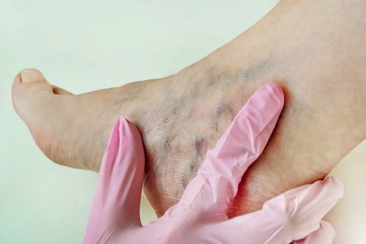Varices.