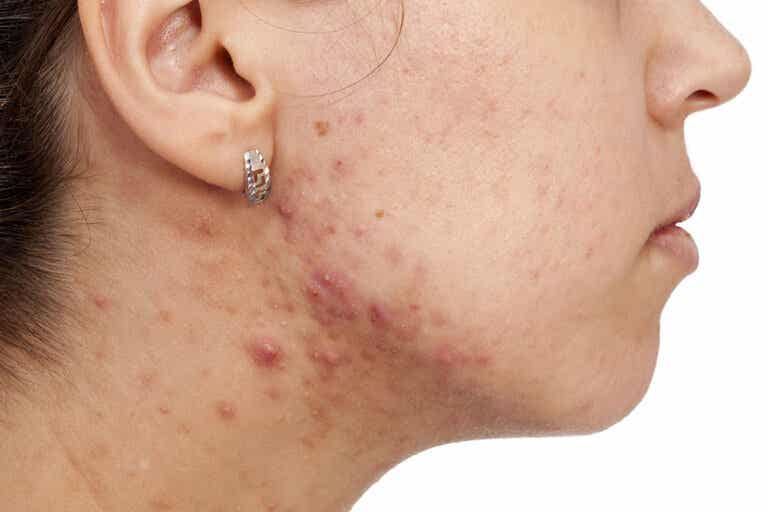 ¿Por qué se produce el acné en los adultos?