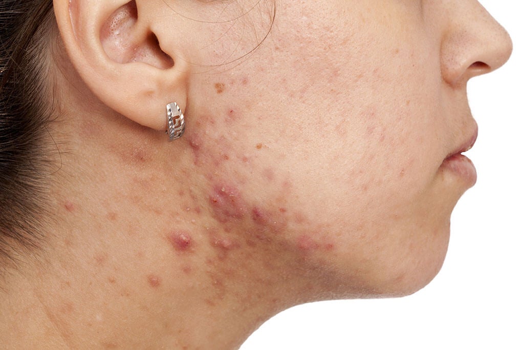 Por qué se produce acné en los adultos.