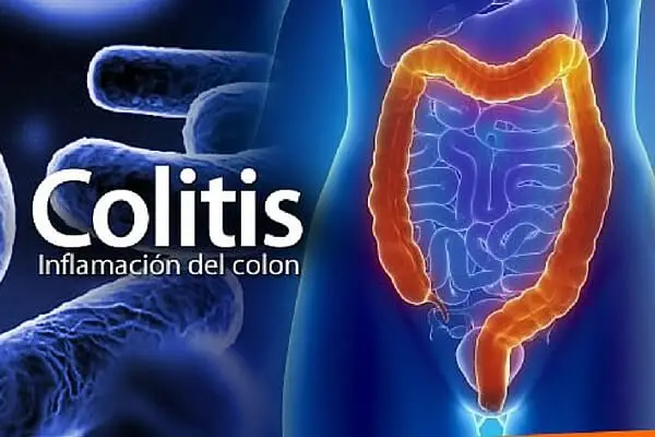 6 tratamientos naturales para combatir la colitis