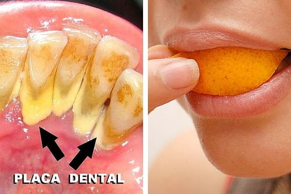 ¿Existen remedios naturales para deshacerse de la placa dental?