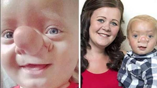 Ollie Trezise: La historia de un niño con encefalocele
