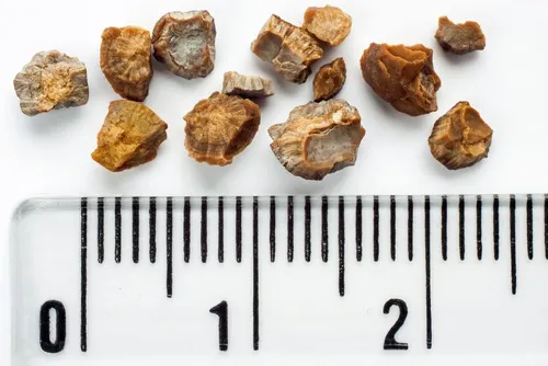 Piedras en riñones