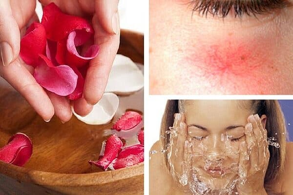 Tips para eliminar las rojeces de la cara