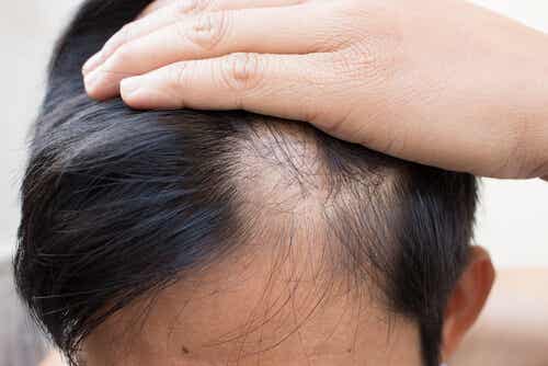 Incluye el zinc en tu dieta para retrasar la alopecia