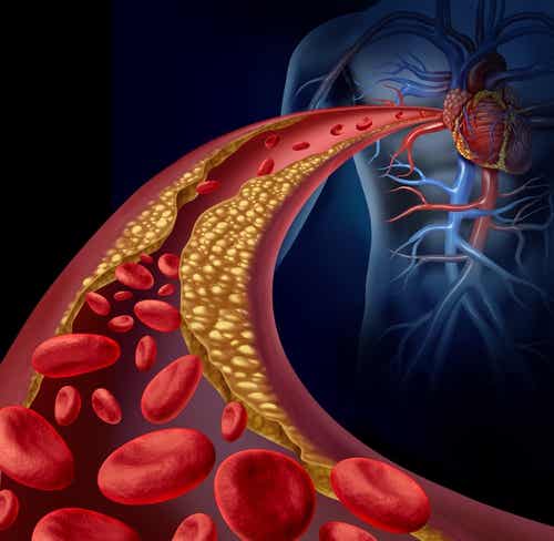 Arteria con aterosclerosis-hipertensión