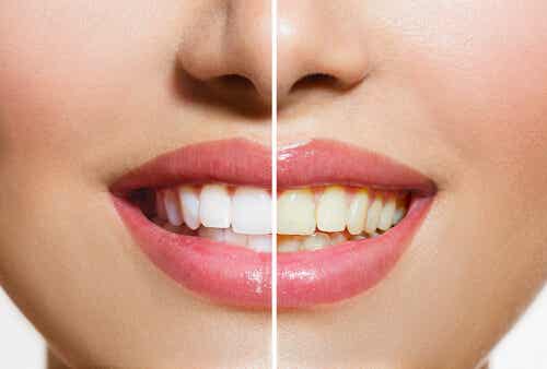 6 motivos por los que tus dientes lucen amarillos