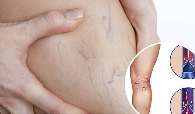 7 remedios caseros para tratar las varices