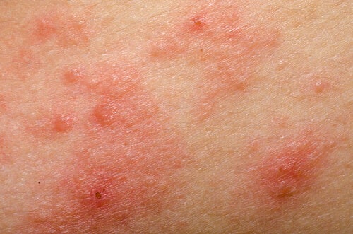 dermatitis en la piel
