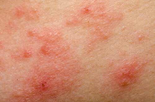 dermatitis en la piel