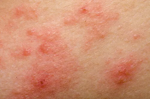 dermatitis en la piel
