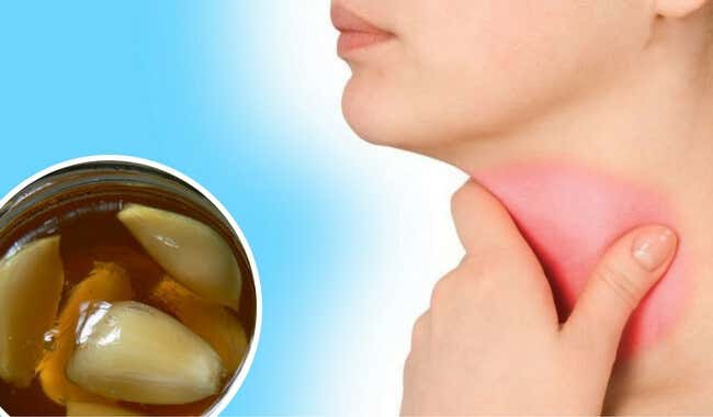 Los 5 remedios caseros que te ayudarán a aliviar el dolor de garganta