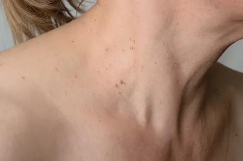 verrugas en las axilas y cuello