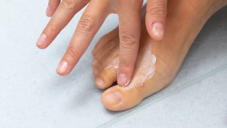 Los 13 mejores remedios naturales para eliminar los hongos de la piel