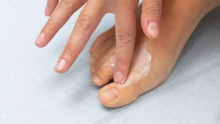 Los 13 mejores remedios naturales para eliminar los hongos de la piel