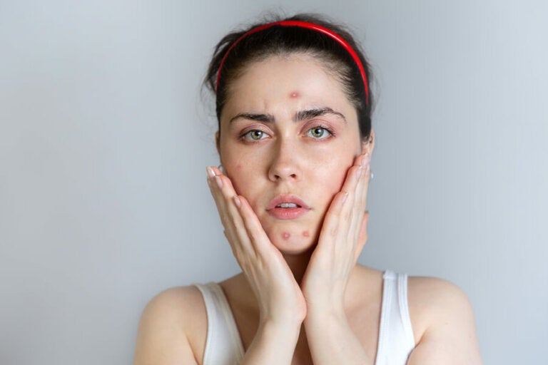 6 tips de belleza para pieles con acné