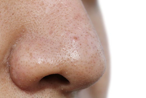 Illinois Hacer un nombre Sustancialmente 7 mascarillas faciales para remover las espinillas - Mejor con Salud