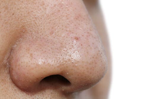 7 mascarillas faciales para remover las espinillas
