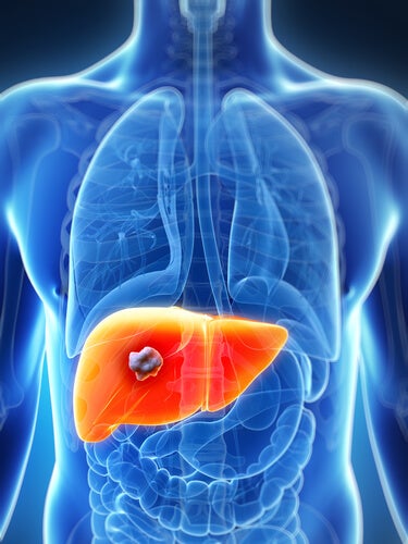 Sintomas de câncer de fígado