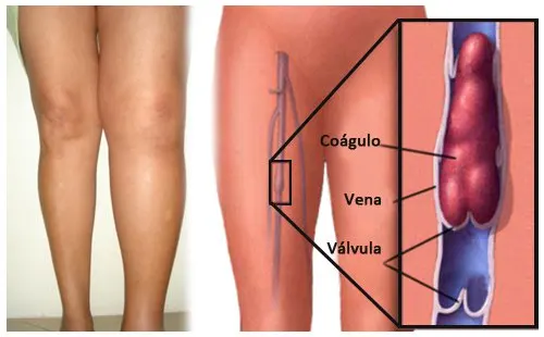 5 cosas que puedes hacer para prevenir la trombosis
