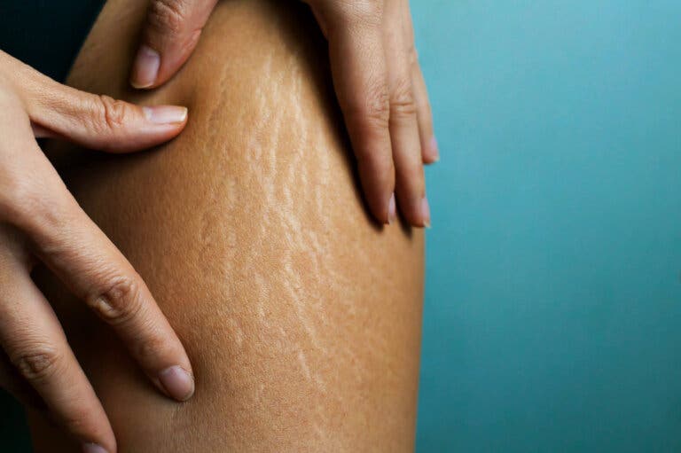 Combate las estrías con esta crema corporal casera