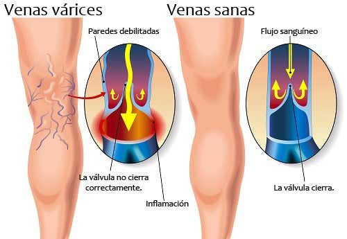 Diferencia entre una pierna sana y una con varices