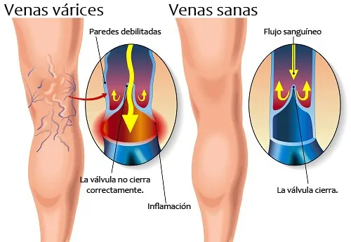 Diferencia entre una pierna sana y una con varices