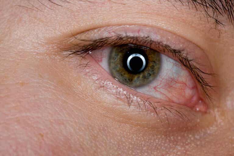 Ojos cansados: 6 remedios caseros para aliviarlos