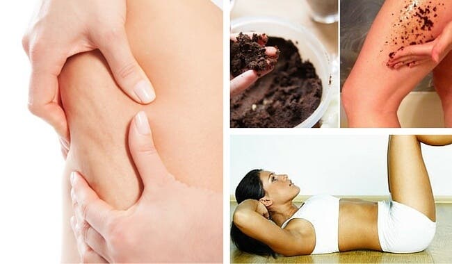 7 consejos para prevenir la celulitis