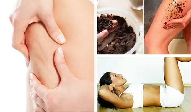 7 consejos para prevenir la celulitis