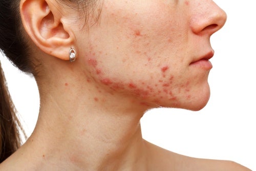 La-miel-ayuda-a-combatir-el-acné